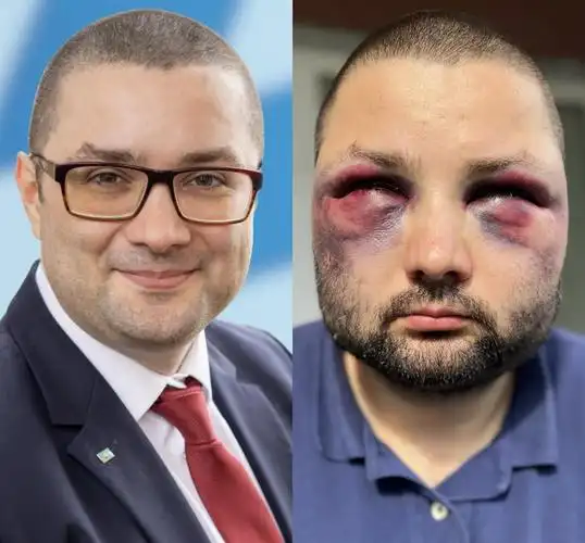 德国一政客回家途中遇袭,被打到鼻青脸肿成"熊猫眼",该政党以反移民