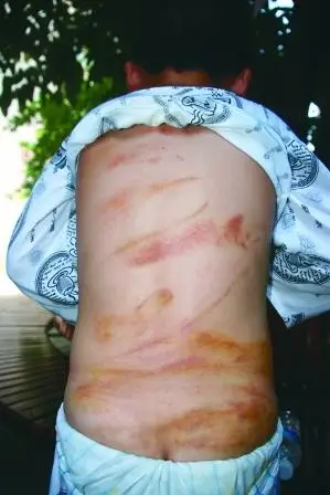 "继母"对9岁男童针刺棒打 致其遍体鳞伤(图)