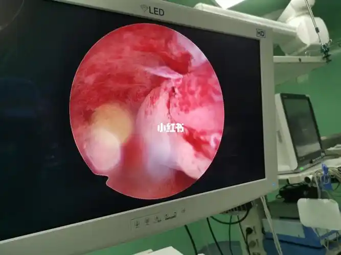 子宫内膜多发息肉   最大块成人中指大小,宫腔镜下等离子电切    32