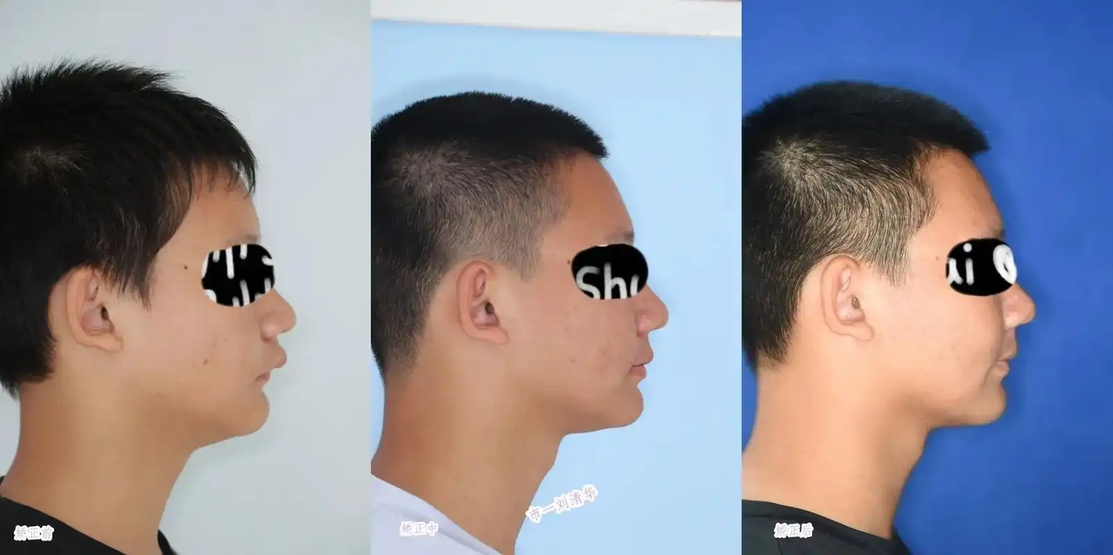 下颌后缩 短下巴 气道 深覆合深覆盖.下颌后缩病例先找出病因 - 抖音