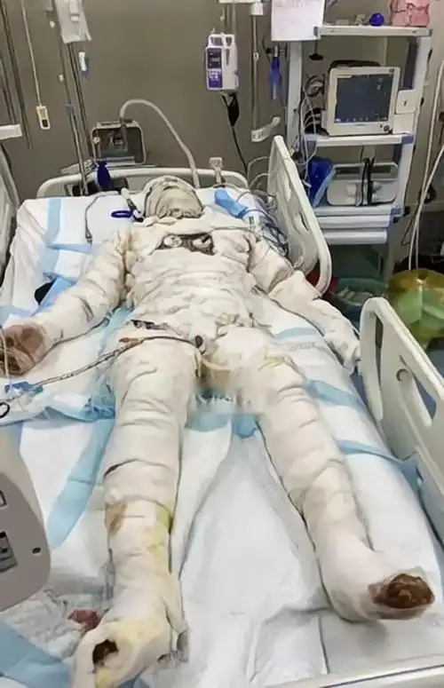 男子火灾救妻去世不到30岁烧伤妻子卧床8天做出决定随你去