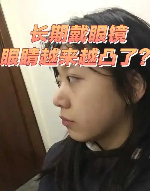 跟啤酒瓶90底一样厚了""取了眼镜,眼睛无神,而且眼球很凸,不戴眼镜