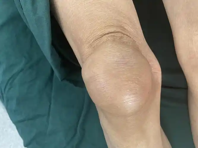 膝部创伤性滑膜囊肿手术一例