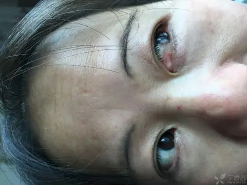 我妈妈的眼睛里有一块腐肉,医生帮忙看一下是什么症状?