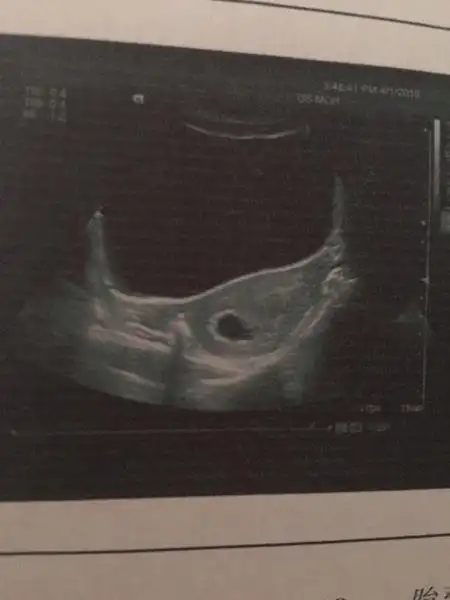 怀孕45天孕囊大小23*20*12是男孩还是女孩?