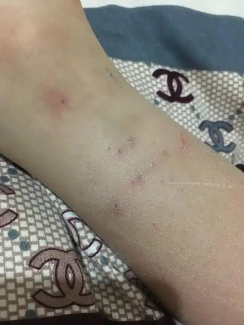 我和大宝被狗虱子咬了几次,痒起来痛苦至极,孩子可以