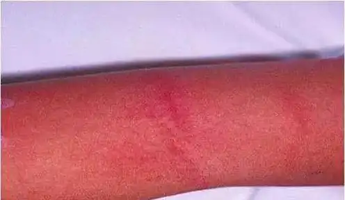 狐大医 | 病毒,细菌感染高发季,真不是感冒咳嗽那么简单