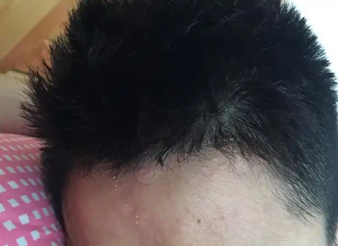 老公 额头上全长这张白痘痘.什么原因啊.严重吗? 谢谢.急