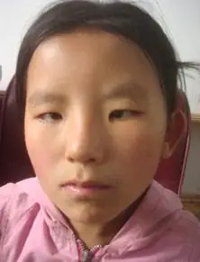 斜视的原理是什么如何识别并改善呢