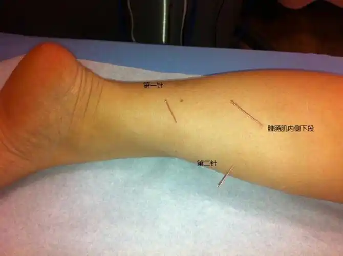 比目鱼肌激痛点针刺,耳鸣立即减轻---又一耳鸣奇案