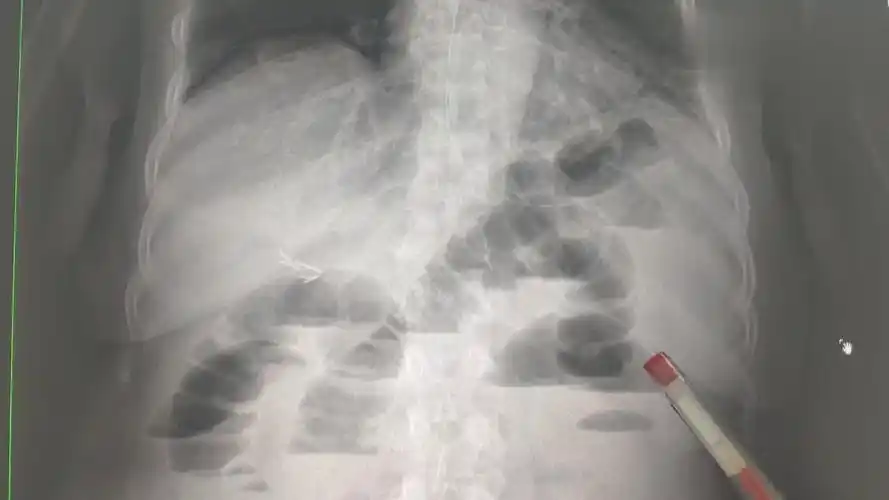 一位典型肠梗阻患者的x线平片,可以看到明显的扩张积气肠管.