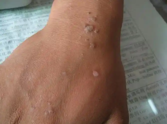 扁平疣图片_扁平疣症状表现图片大全_有来医生