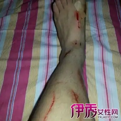 【图】真实脚受伤带血图片展示 四个教你如何保护脚部的方法