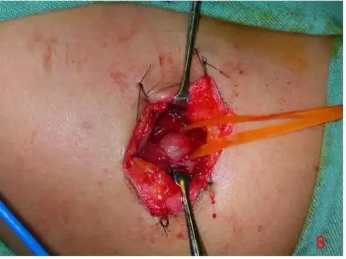 20140326结节性筋膜炎ppt