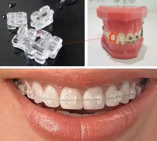 牙性龅牙的五种矫正方式是什么,它们都有什么优缺点?