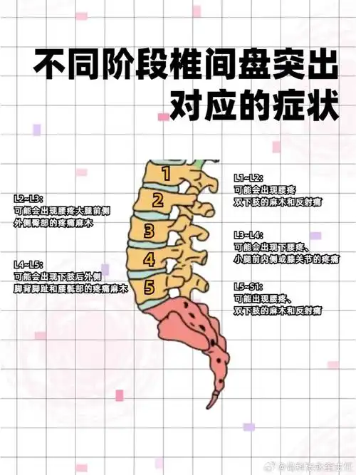 腰椎间盘突出##中医