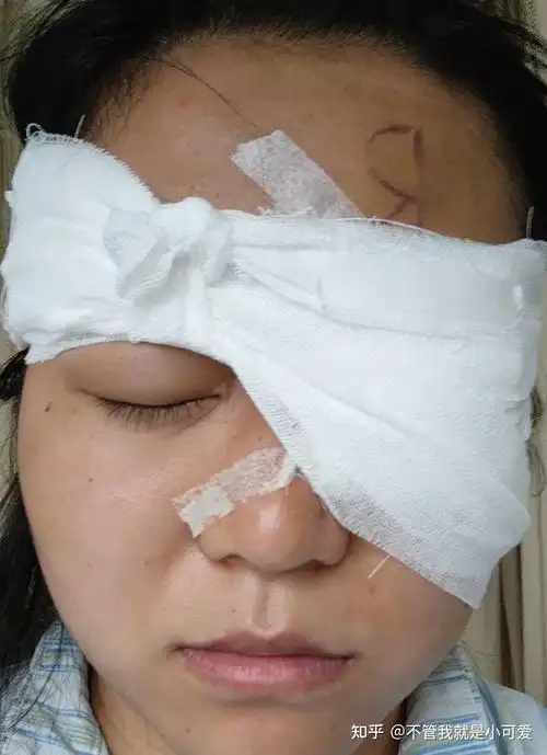 节了医生都放假了,就有值班的在,然后还是实习医生小姐姐给我拆纱布