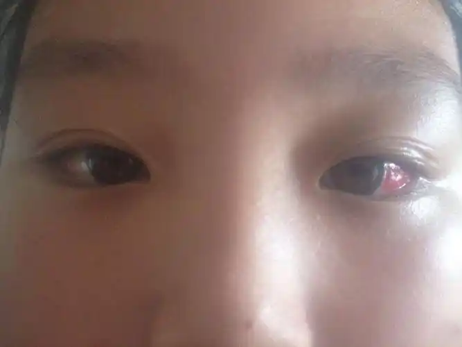 做完外斜视手术后的第二天右眼充血更严重了怎么办?现在第三天更大了.
