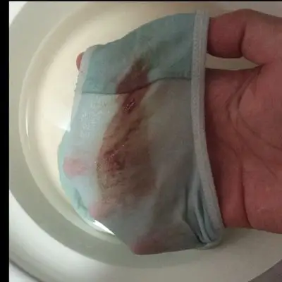 今天下午发现短裤上又流血了(之前在2个多月的时候有一次先兆性流产)