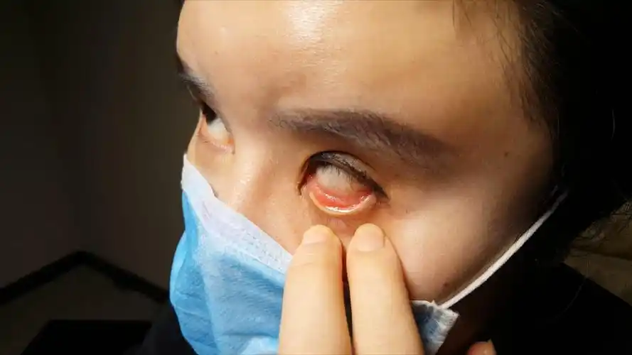 整容手术后 多名女子患上干眼症 角膜受损