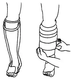 足踝石膏绷带包扎步骤