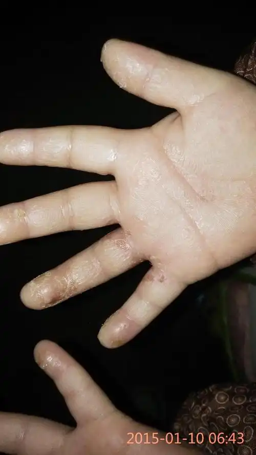 我家宝宝,最近几天手指上有掉干皮和水泡脓包,会益出水来.