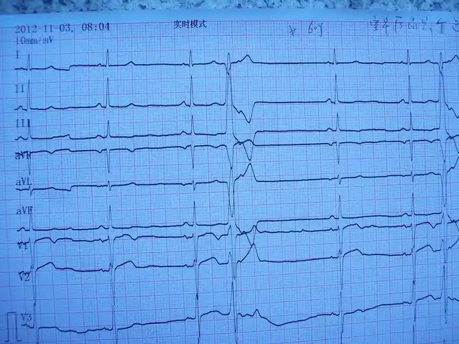 室性早搏? 交界性早搏? - 心电图脑电图专业讨论版 - 爱爱医医学论坛