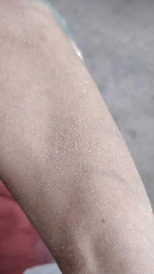 身上这个白皮是什么啊,怎么洗都洗不掉