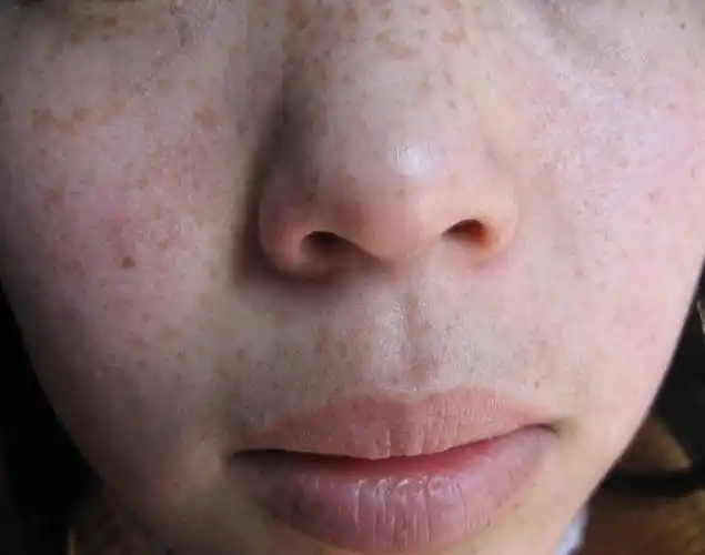 如何治疗遗传性雀斑_石家庄明德中医院,石家庄皮肤病医