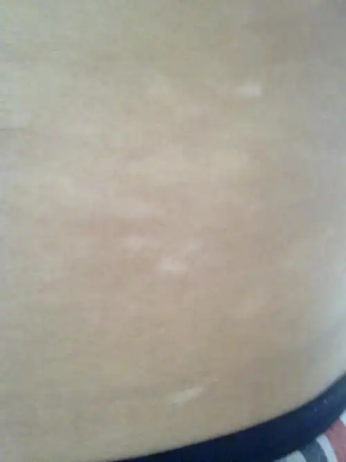 01白癜风:这是最常见的白斑,往往表现为瓷白色.