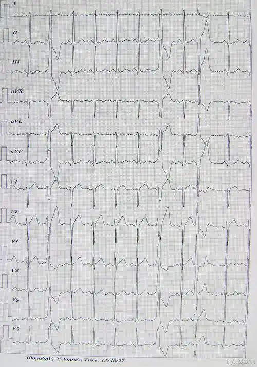 动态心电图中许多异性的室性早搏讨论下