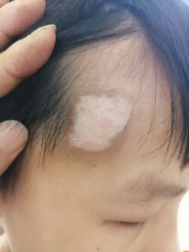 写美篇  所以,要想早日恢复健康,就不能被白斑的表象所迷惑,坚持治疗