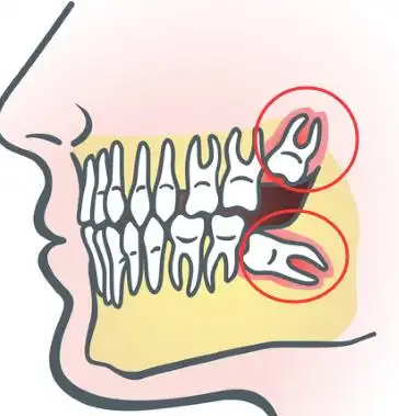 哪几种智齿需要拔牙哪种智齿拔牙难度大