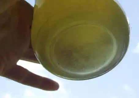 才能确定这种情况导致多余的蛋白质从尿液中排出,并可能导致泡沫尿