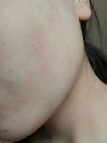 皮肤问题,干燥,粗糙,一片起皮,连续好多天,涂保湿水刺激会疼,只敢涂