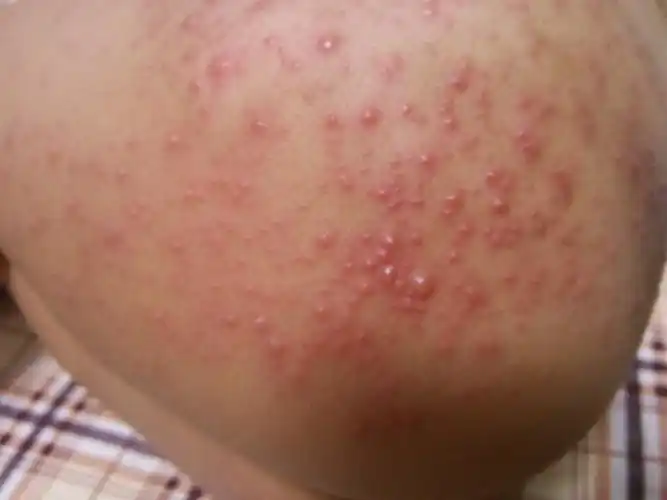 快三岁的宝宝,半边臀部长满了红点和水泡,看起来好