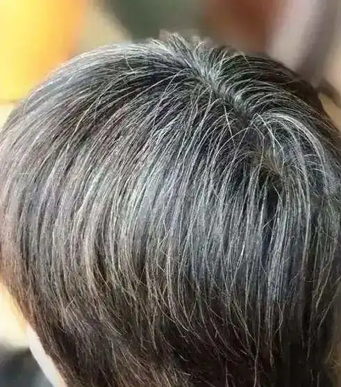 影视剧中一夜白头的情况到底是什么原因导致白发增