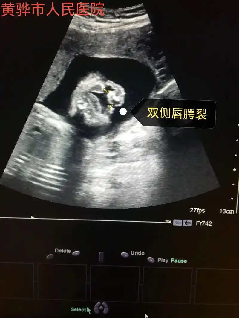 胎儿专场,24周四维胎儿唇腭裂,其他暂时未发现异常,需要评估 - 抖音