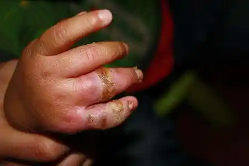 2岁宝宝手部化脓感染啼哭不止, 家里有它的家长要注意了!