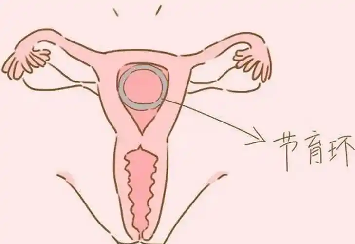 避孕环图片(迷路) - 赤虎壹号