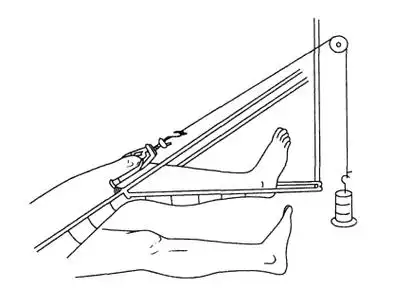 2,操作步骤胫骨结节牵引过久,牵引钉松动或钉孔感染,必须换钉继续牵引
