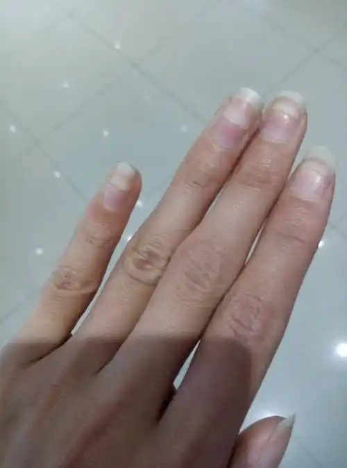 我今年二十一岁,男性,我指甲一直这样自己分层了都两三年了,两个手的
