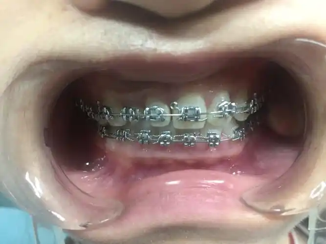 牙齿中线偏斜,求矫正. - 好大夫在线