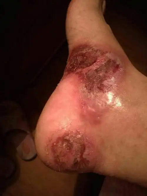 因脚上多年皮肤病一直没看好,前不久用其它产品感染发炎皮肤严重溃烂