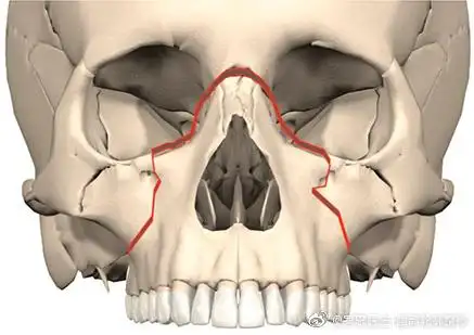 正颌手术# le fort ii型骨折:又称上颌骨.