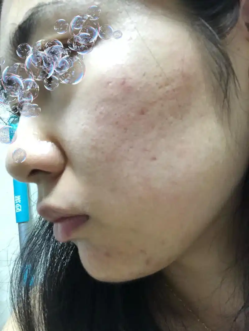 效果还是有的_换肤_果酸_美妆_医美整形