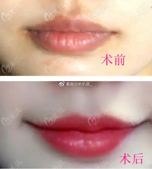 做了微笑唇让人后悔的后遗症有哪些会不会哭也像笑