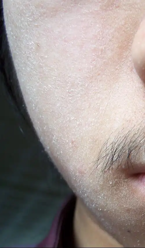 我的脸这些日子不知为什么特别干,都起皮了.