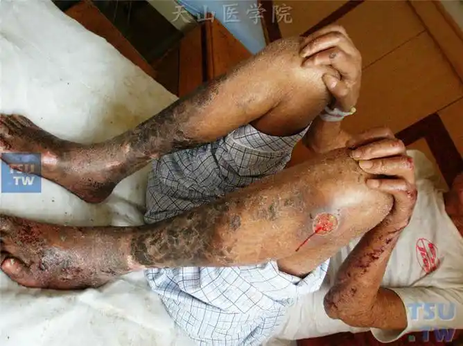 瘤型麻风:双小腿可见皮肤轻度变硬,光滑发亮,出现鱼鳞样或蛇皮样损害