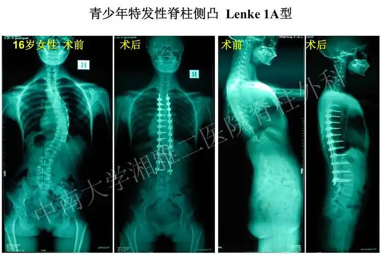 脊柱侧凸暑假班:浅谈22个需要知晓的问题